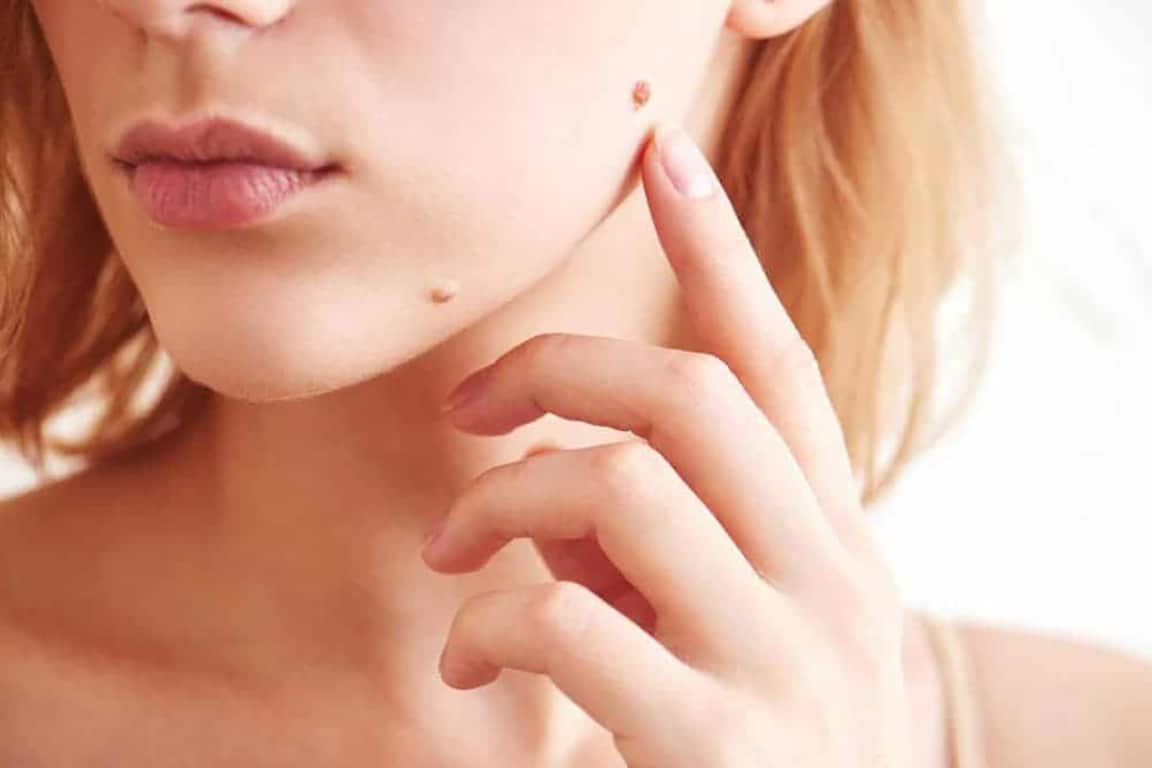 Comment repérer les grains de beauté